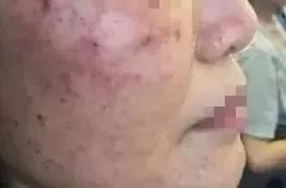 做激光大概多少钱,激光费用大概是多少