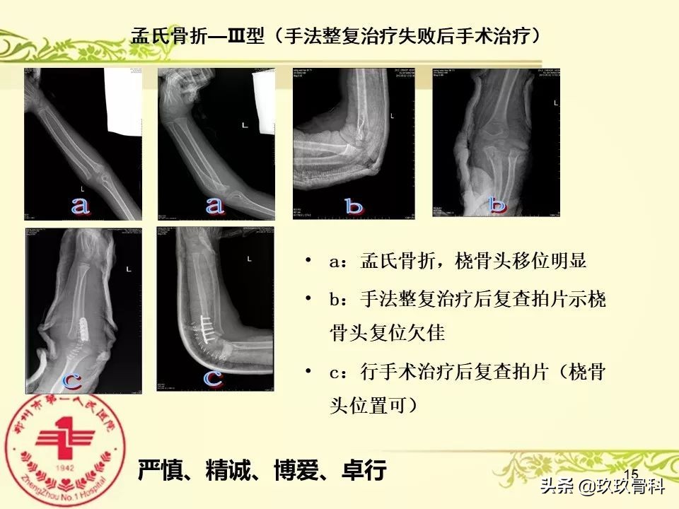 孟氏骨折功能训练多久能恢复正常,孟氏骨折中医能治吗