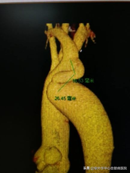 介入手术导致血管变细,血管扩宽的手术叫什么