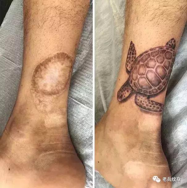 疤痕体质可以用纹身去遮盖疤痕吗,你的疤痕是什么颜色呢