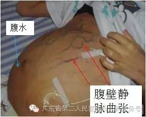 肝硬化时门静脉高压症形成的原因,肝硬化门静脉高压的症状原因