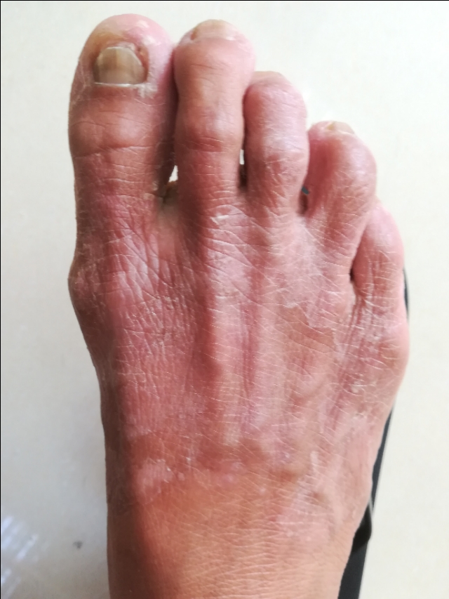 干燥敏感皮肤夏天怎么护理,夏天脸部皮肤脱皮干燥怎么办