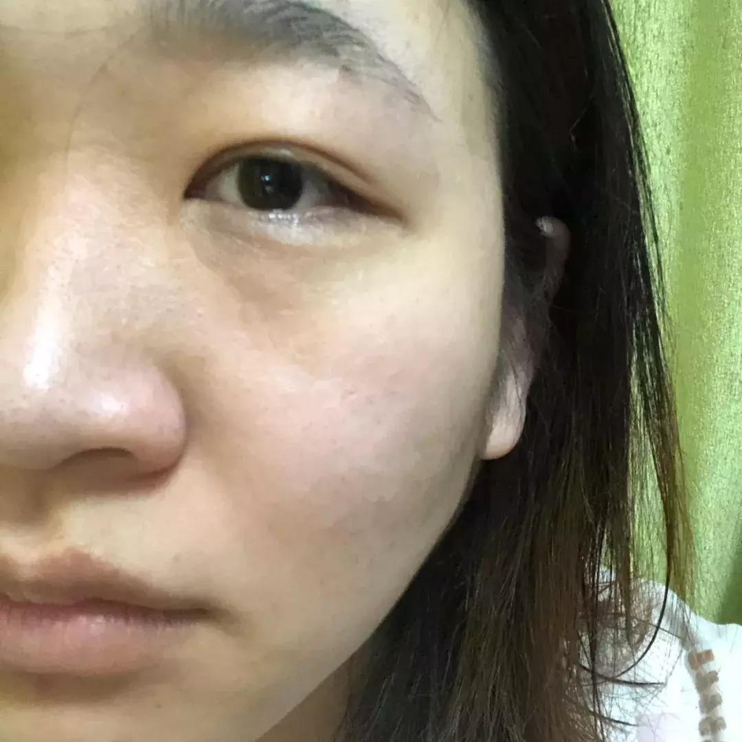 激光祛痣怎么好得快不留疤,激光祛痣亲身经历和感受