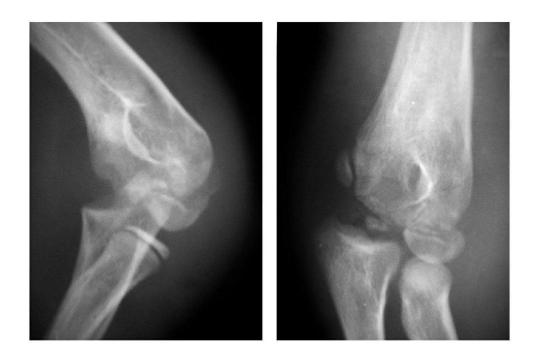 青少年肘部损伤最常见的是,肘部桡神经损伤的临床表现