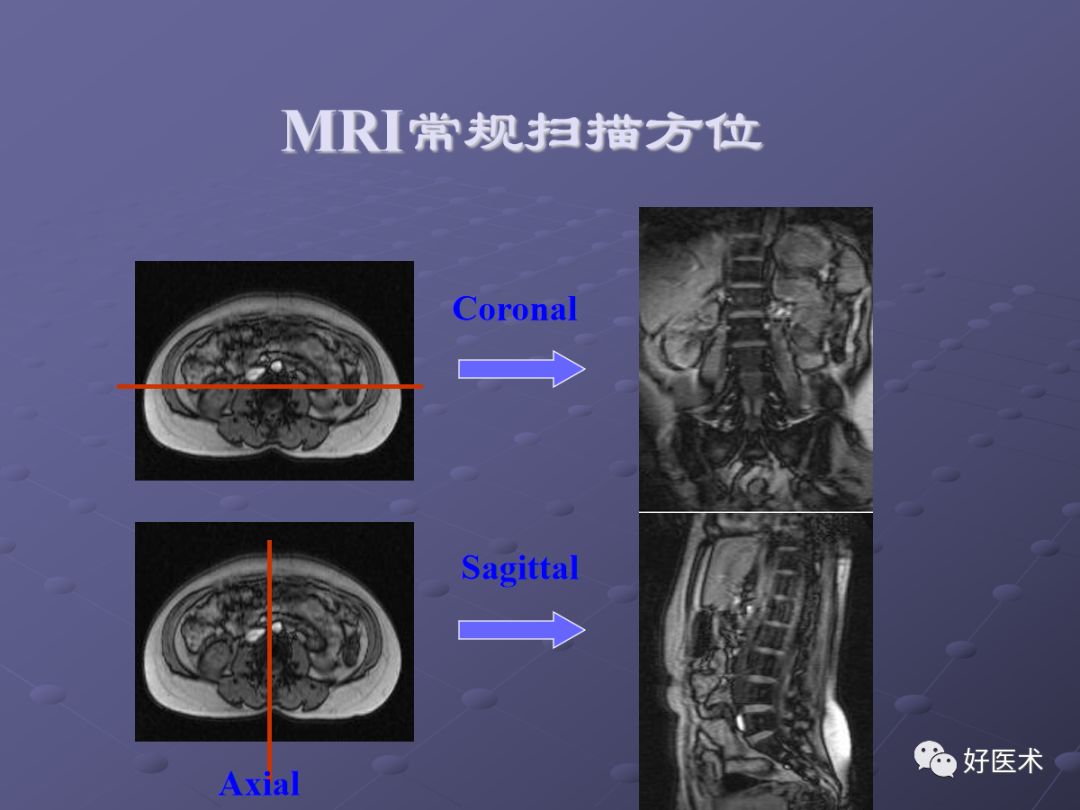 脊柱mri有哪些特点,乳腺疾病的mri诊断及鉴别