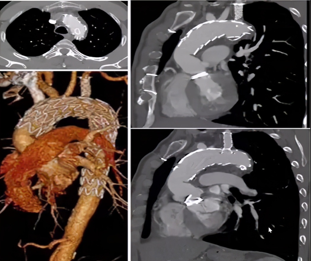 胡佳:升主动脉近端手术后新发弓部病变的腔内治疗