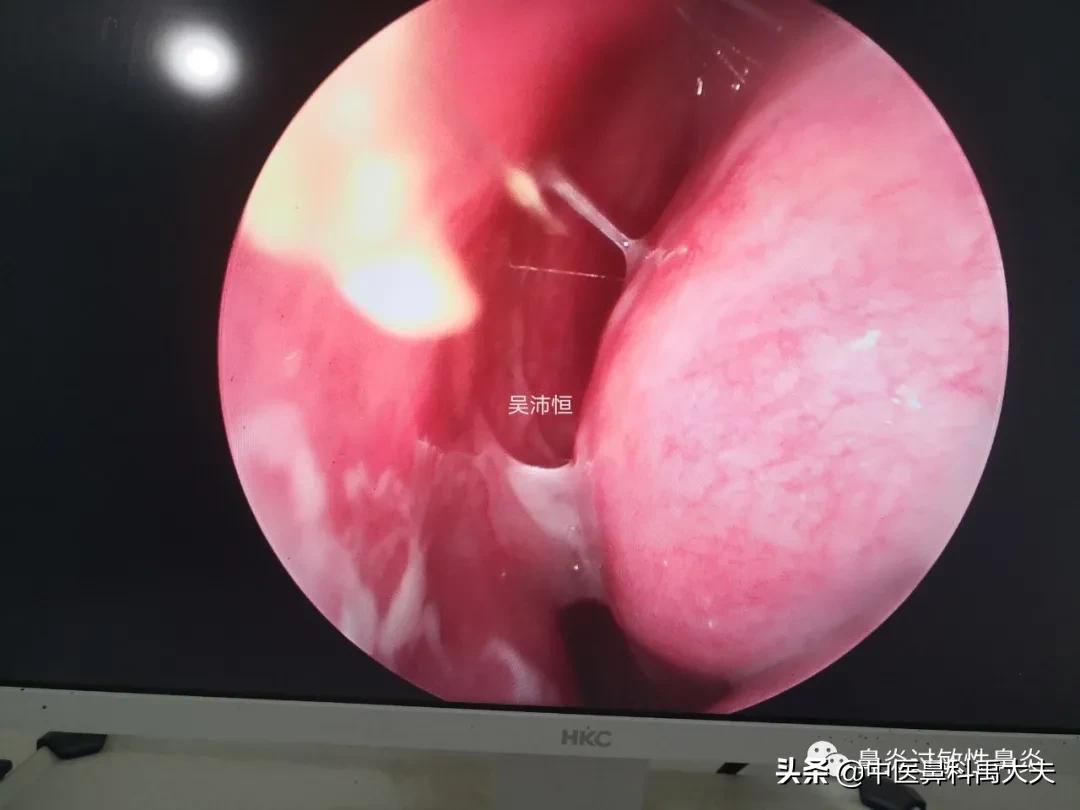 鼻窦炎流黄脓鼻涕10天了怎么办,鼻窦炎没鼻涕通气为什么头晕头痛