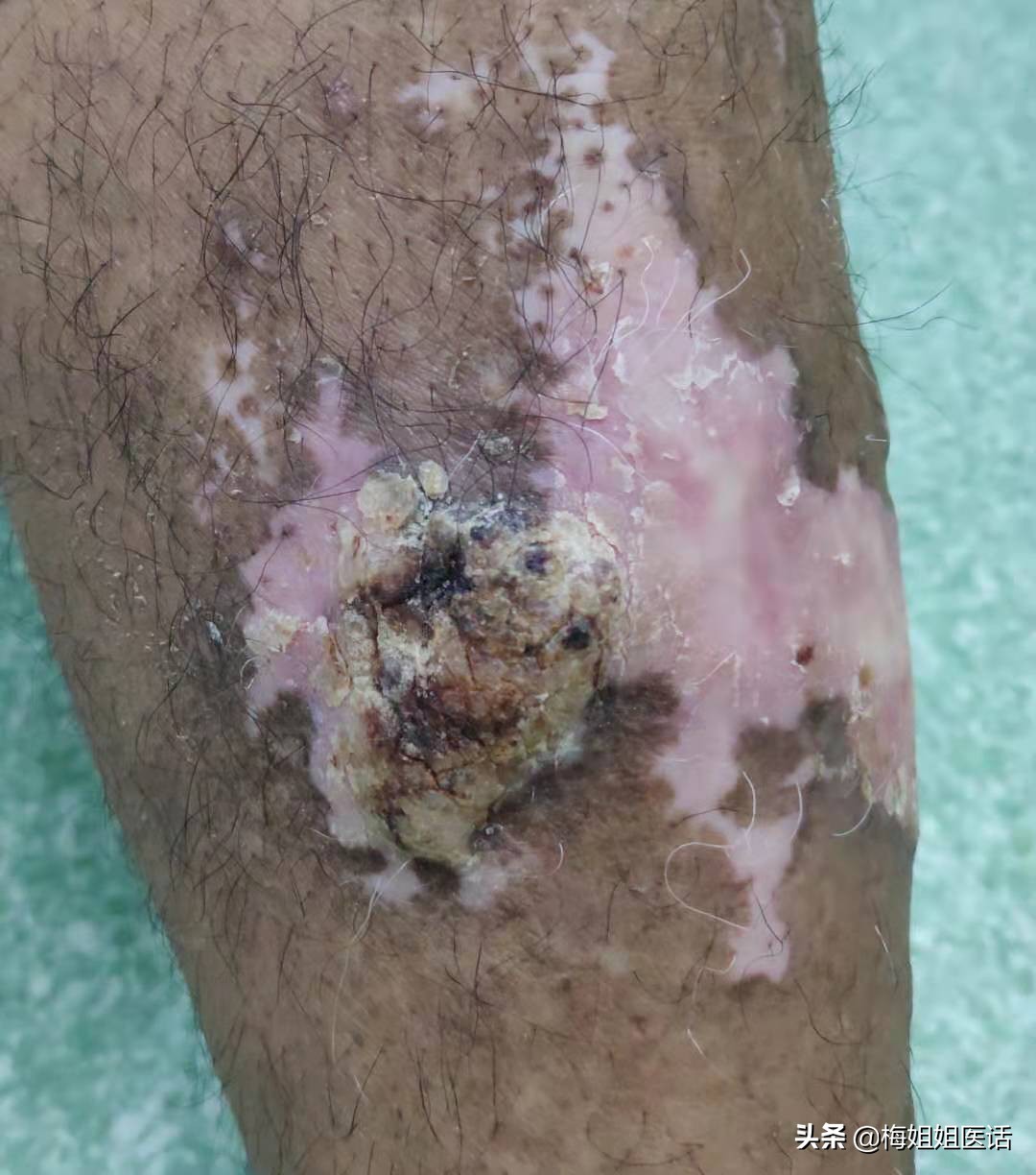 拒绝瘙痒,手皮疹越来越痒