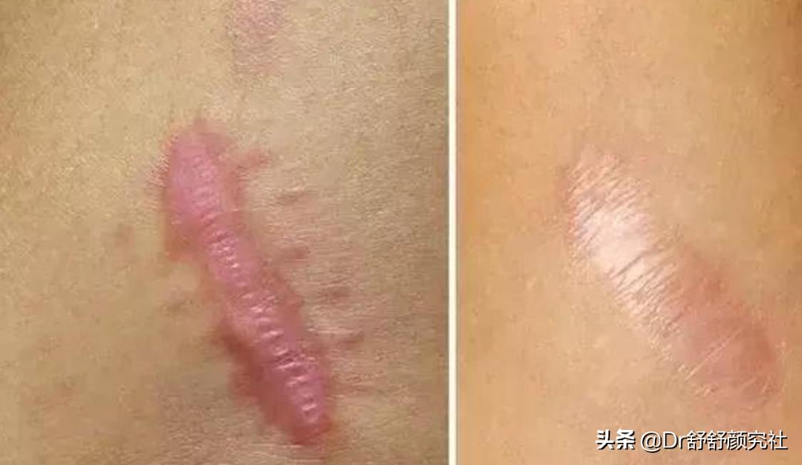 消除瘢痕疙瘩的药膏,胸口瘢痕疙瘩的危害