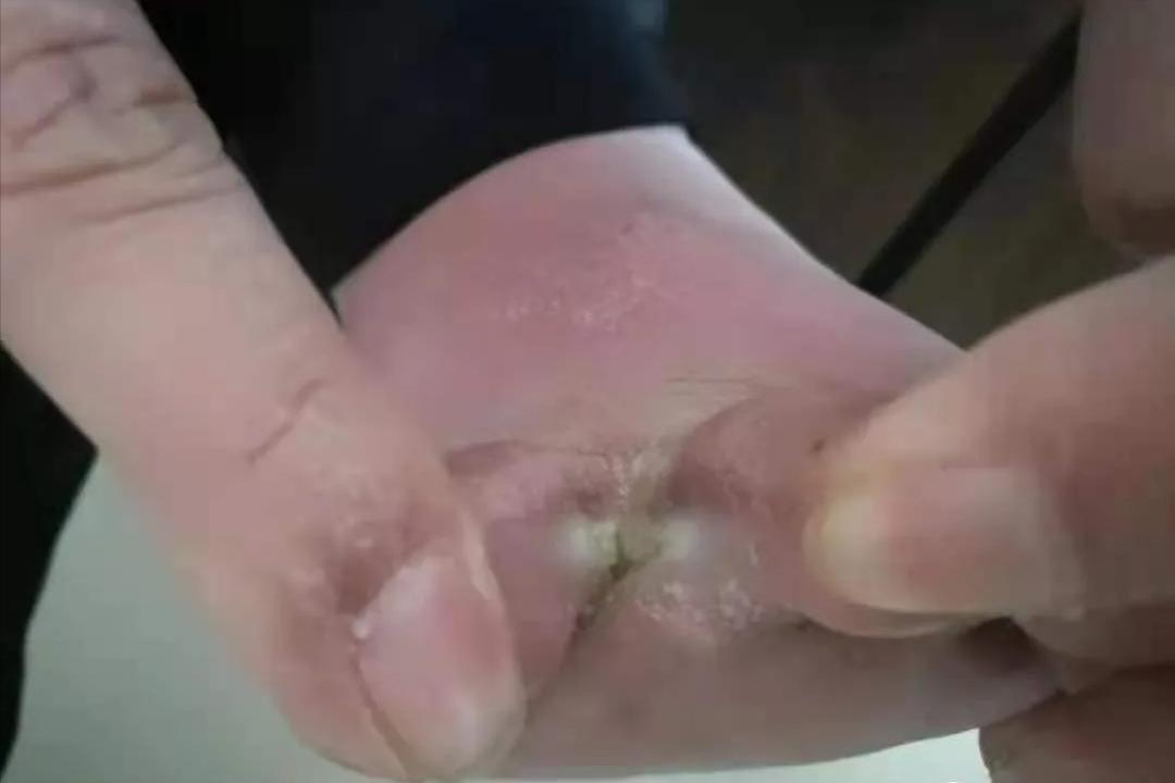 脚气会通过床单传染吗,脚气到底是怎么传染的