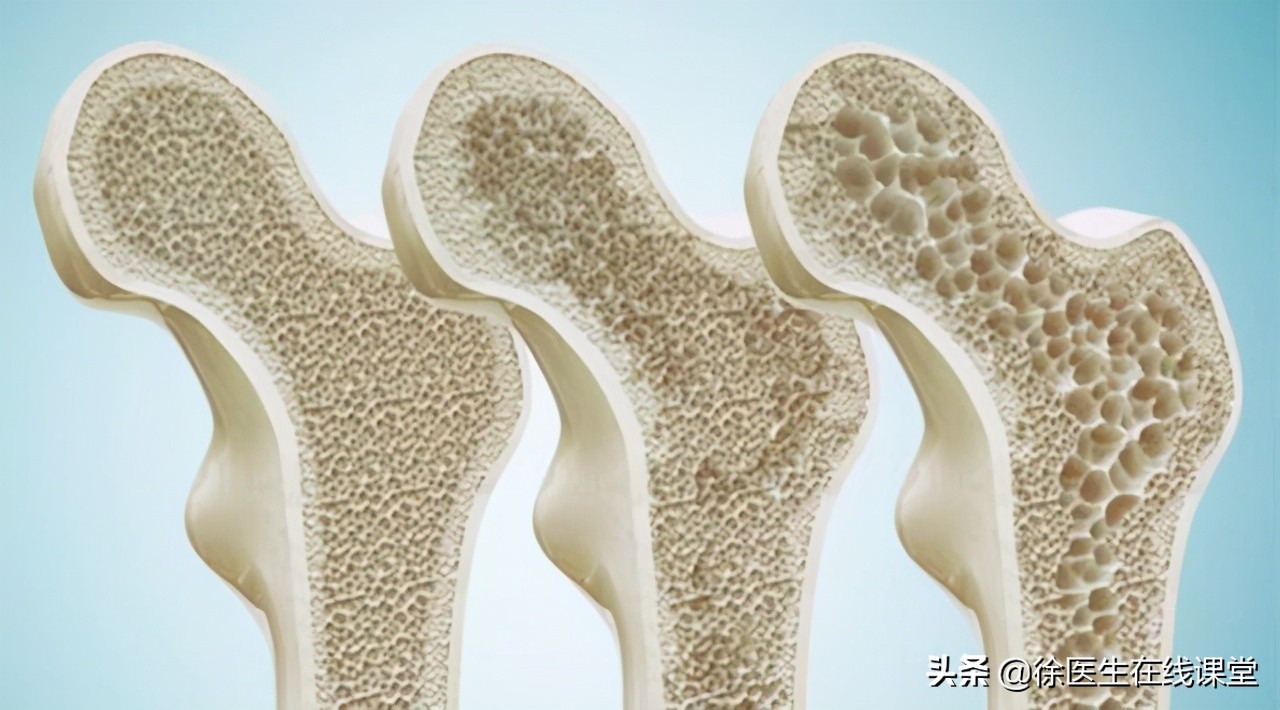 中年人得了骨质疏松怎么办,老人骨质疏松腿疼怎么缓解