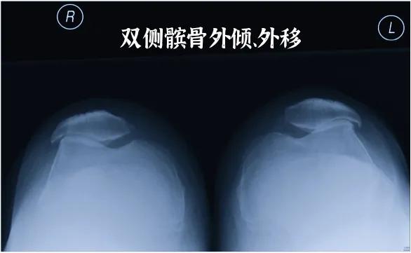 膝盖髌骨上下楼梯疼痛怎么办,髌骨外倾可以矫正过来吗