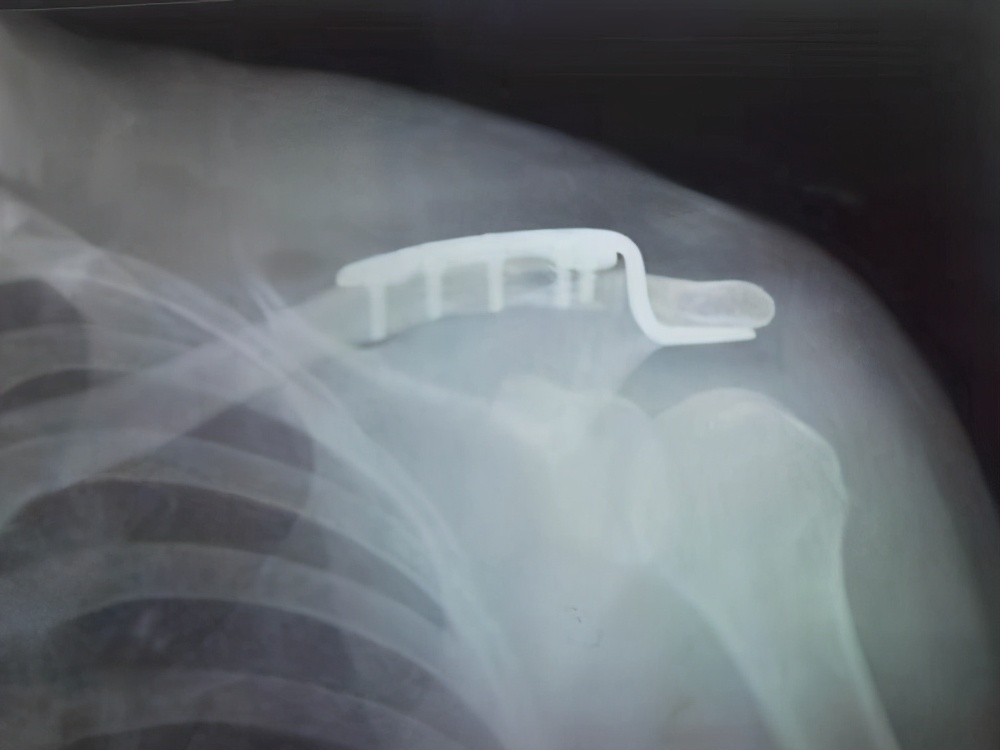 骨折上的钉还用取出来吗,骨折放的钢板是铁的吗