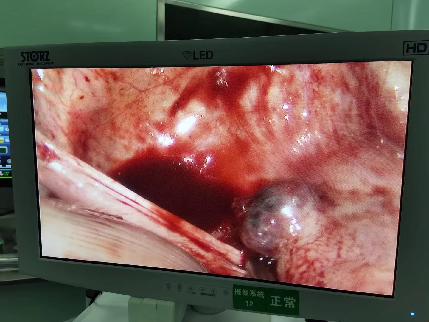 人流术后子宫感染一直腹痛怎么办,人流术后半个月腹痛腰痛