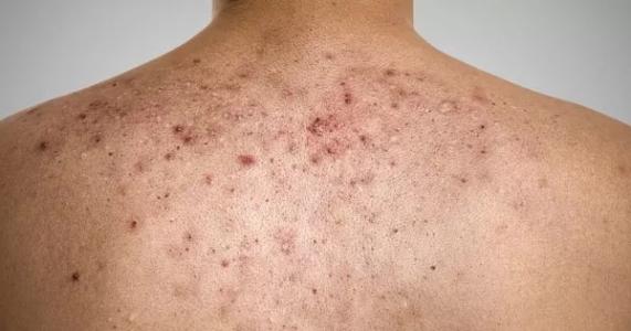 背上长痘痘不痒涂什么药膏,背上的痘痘可以快速消下去的方法