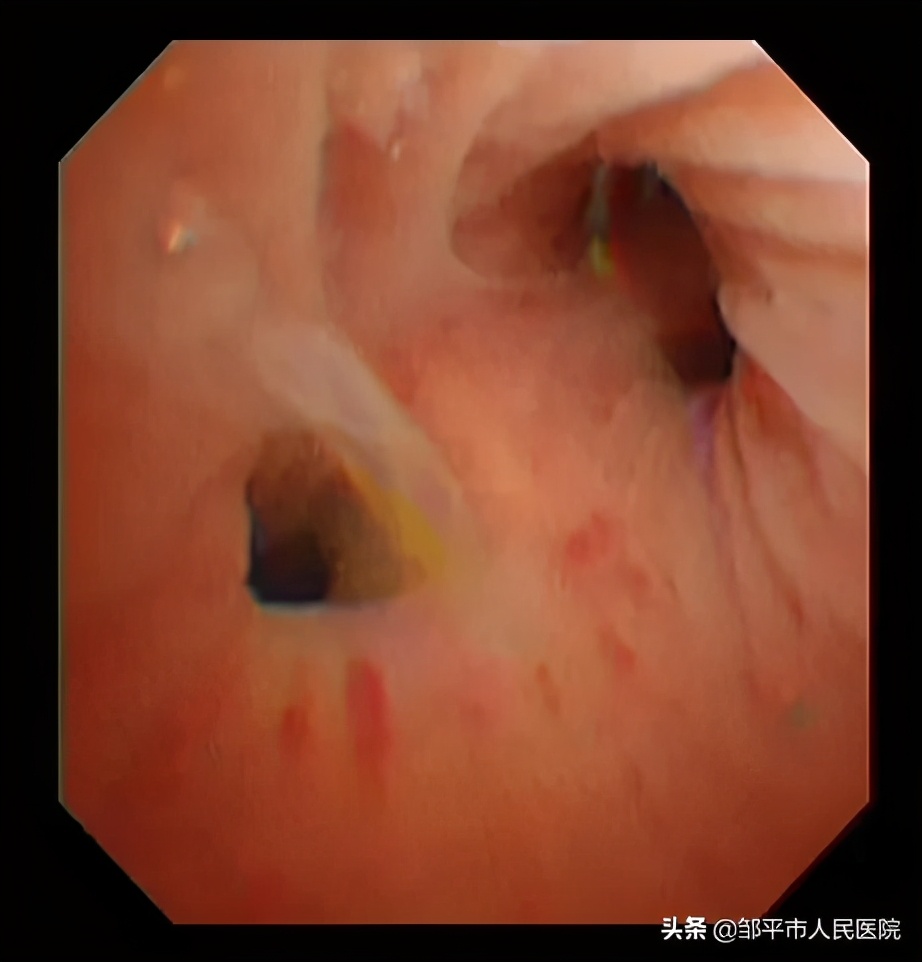 重症肺炎最佳治疗方法,满月宝宝重症肺炎如何治疗