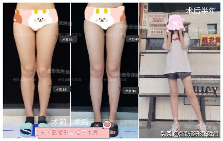 大小腿吸脂后走路,大小腿吸脂可以修饰腿型吗