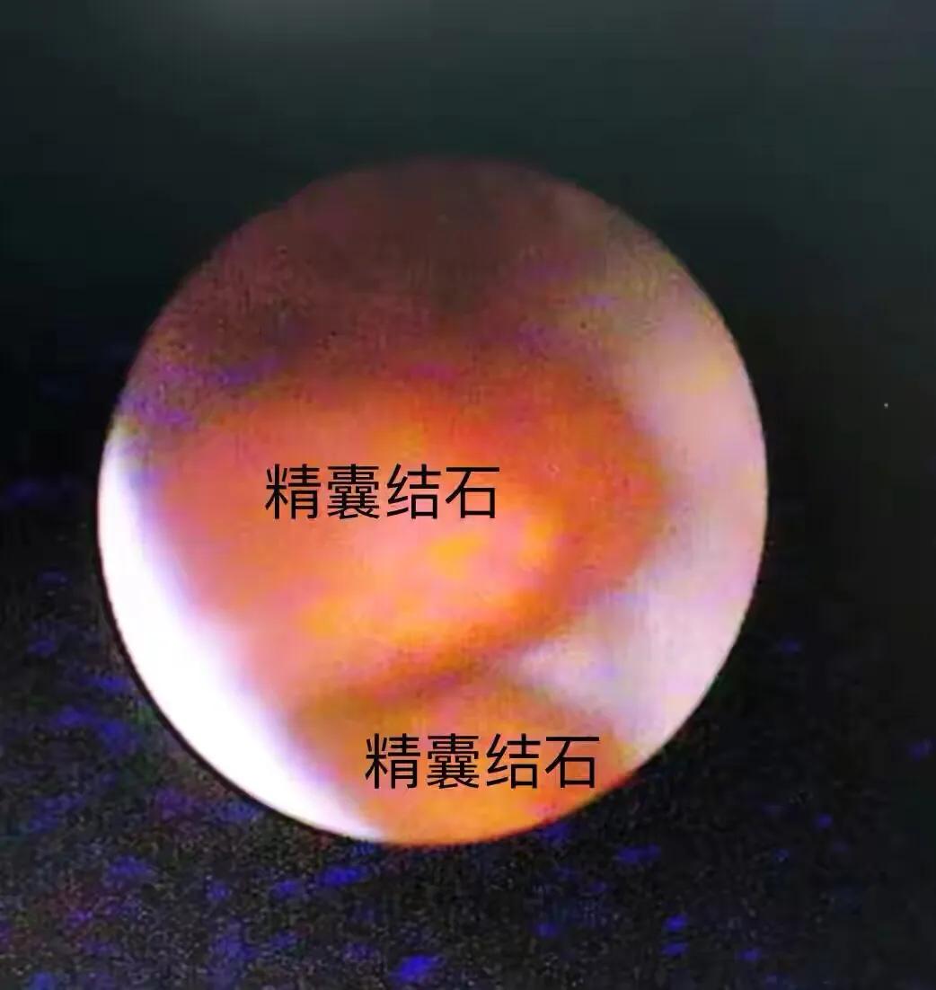 前列腺钙化灶可以用冲击波治疗吗,治疗前列腺钙化灶的药物有哪些