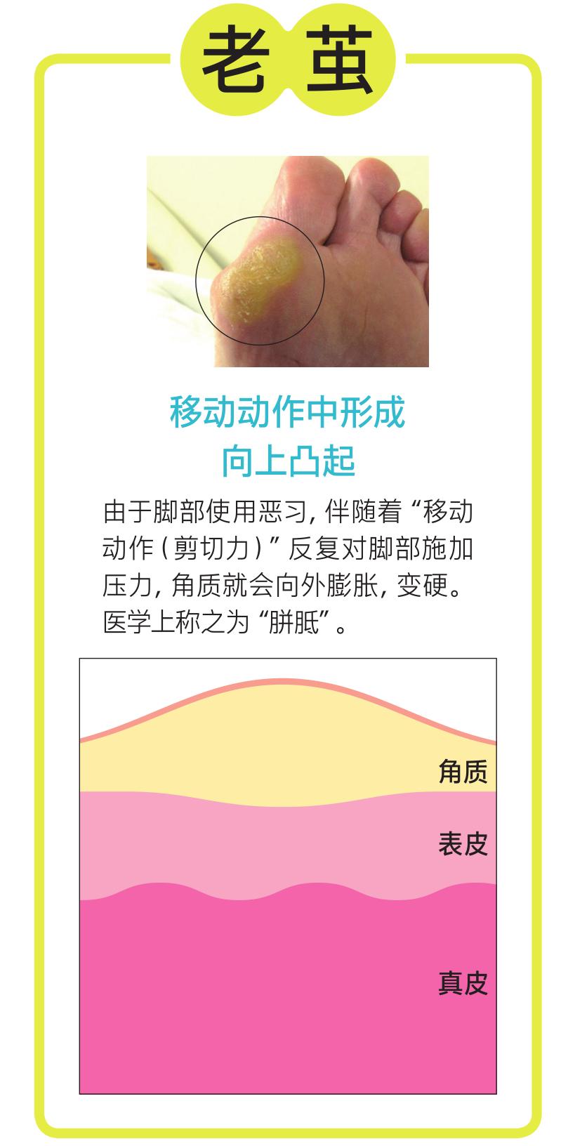 硬邦邦的老茧，会痛的鸡眼，日本皮肤科专家教你矫正足部恶习