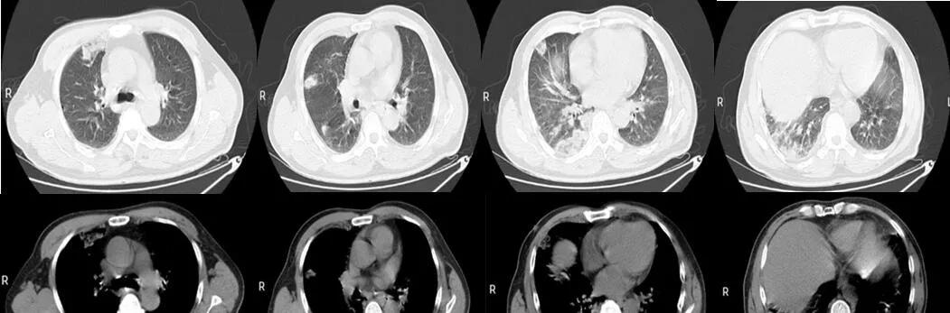主任医师查房：这个“肺空洞”不简单