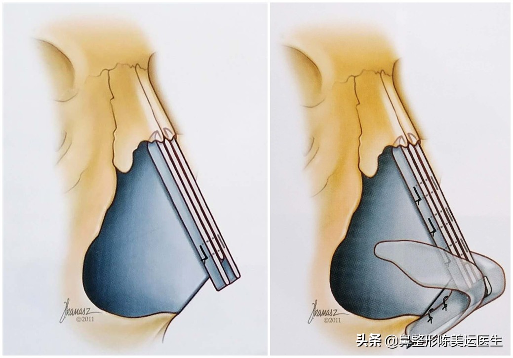 短塌鼻子可以做成直鼻吗,塌鼻子怎么能变成尖鼻子