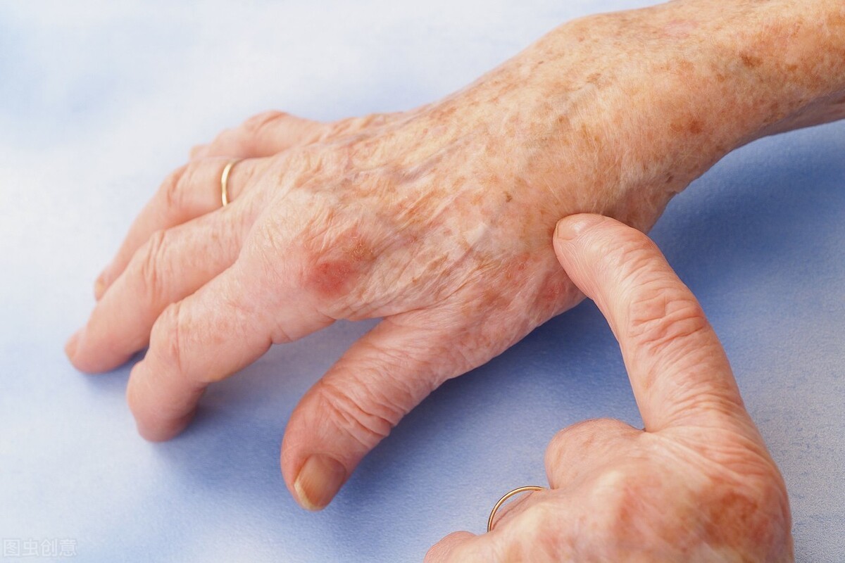 一分价格一分货？非布司他与别嘌醇，对抗痛风有啥不一样