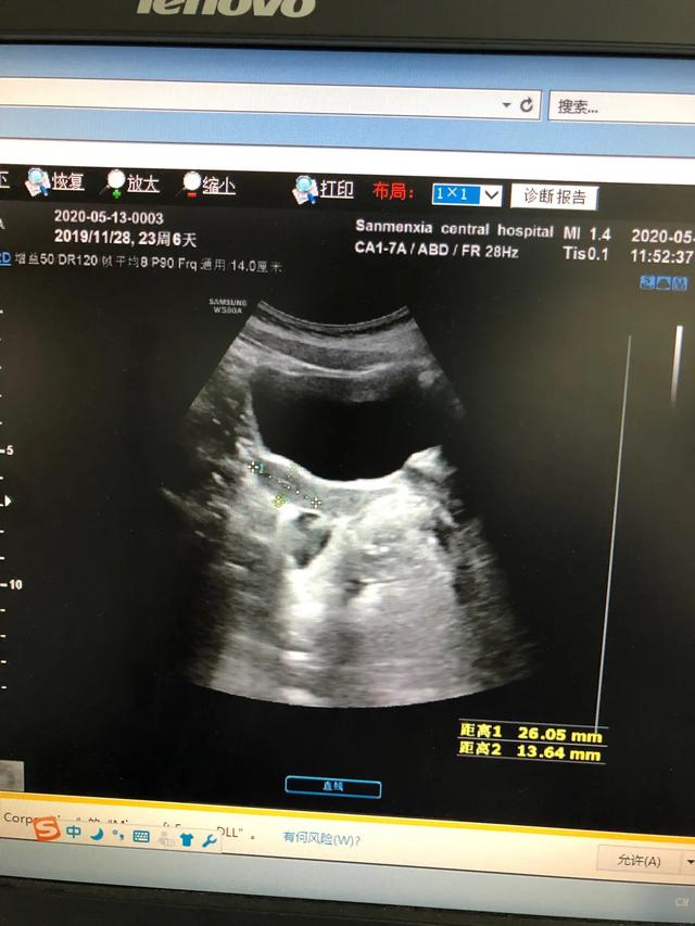 儿童性早熟要做哪些检查？怎么根据这些指标判断真性还是假性？