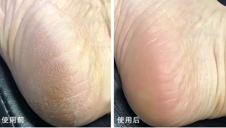 脚上老茧太厚了走路不舒服,脚上老茧不硬了发黄