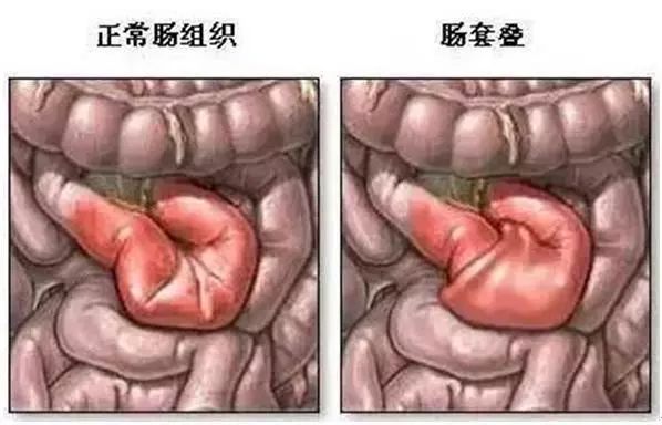 14个月宝宝肠套叠是什么症状,肠套叠的三大典型症状肠胀气