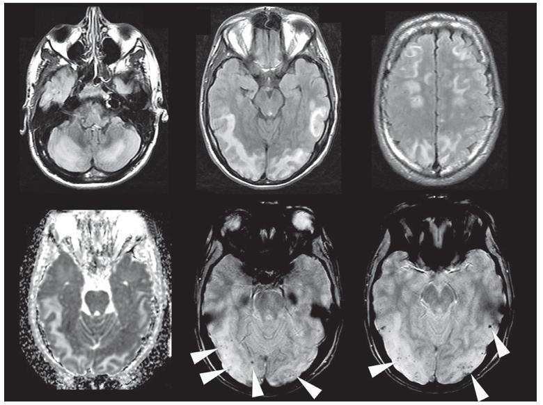 头疼做磁共振脑小血管有点出血,核磁共振说脑血管出血