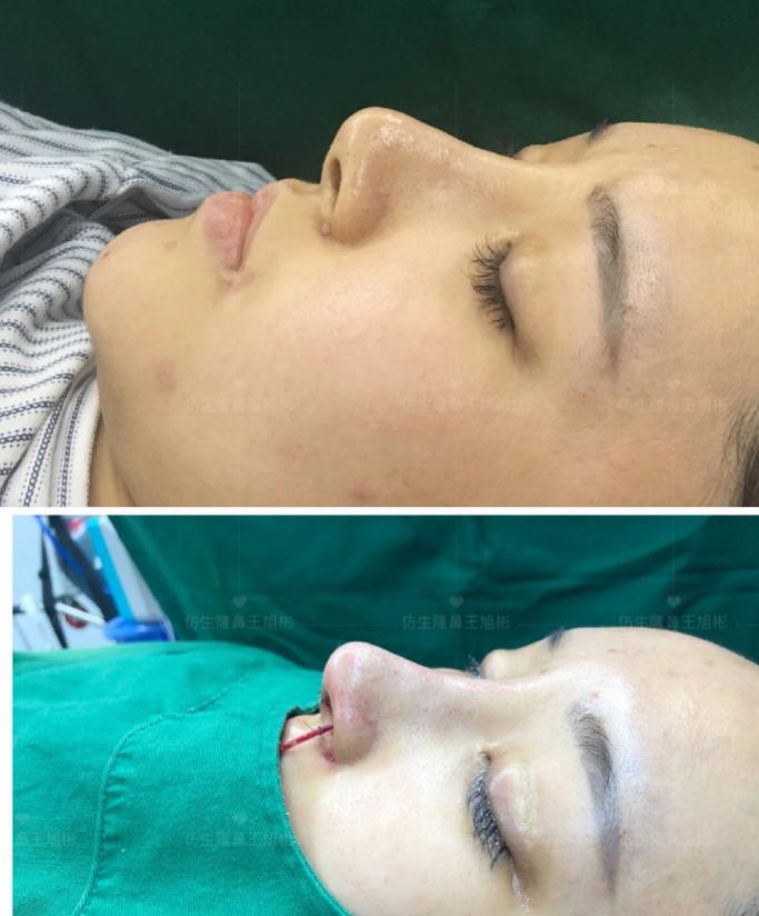 线雕隆鼻后鼻综合修复术,隆鼻失败修复手术真实案例