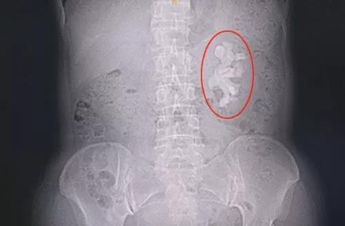 肾结石开刀后怎么调理,肾结石微创手术有两种方法