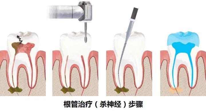 蛀牙不补能不能戴牙套,蛀牙不补认真刷牙可以防止变严重吗