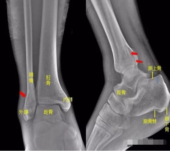 怎样发现骨折的可能性,一招看出手指骨折