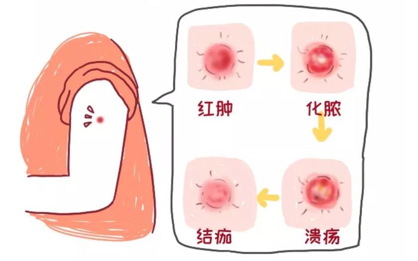 儿童接种疫苗不良反应及处理办法,儿童接种完疫苗后的不良反应