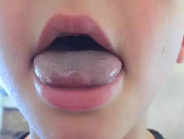 孩子舌头被饮料瓶困住,小孩喝水舌头被卡杯盖