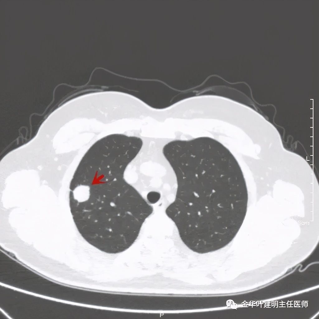 右上肺结节灶一般是什么癌,右上肺恶性肿瘤是肺癌吗