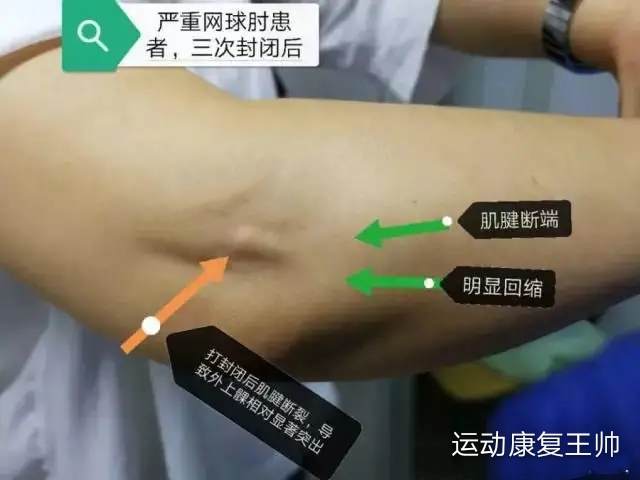 得了网球肘打封闭针好吗,得了网球肘打封闭针行不行