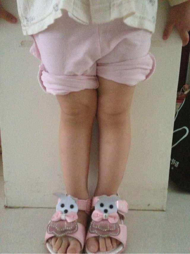 宝宝小腿短注定矮个子吗,小孩腿部有多处又硬又红
