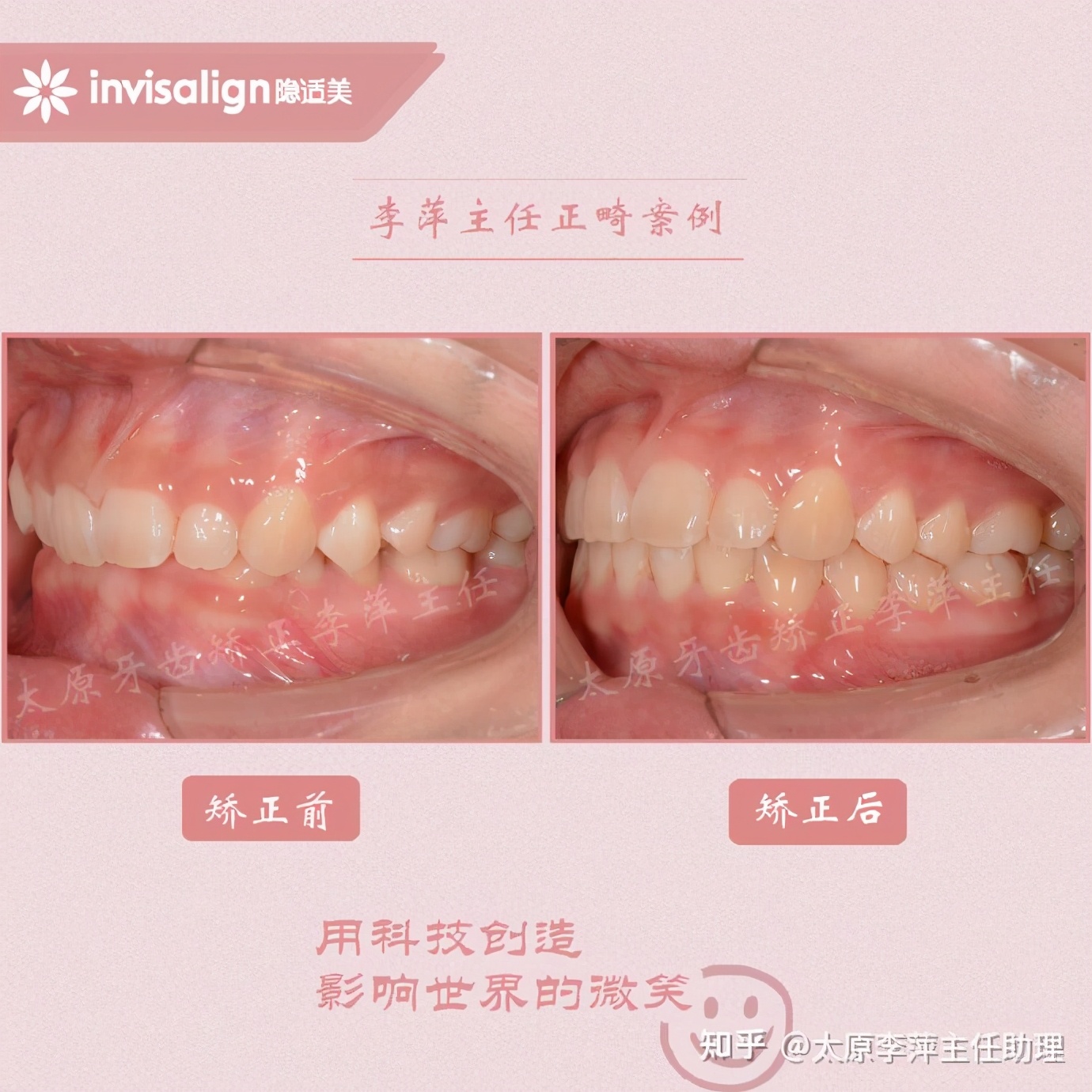 太原矫正牙齿需要做正颌吗,太原牙齿二次矫正