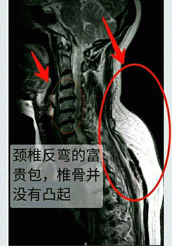后脖颈下富贵包痛怎么快速治疗,颈后部是富贵包还是肿胀