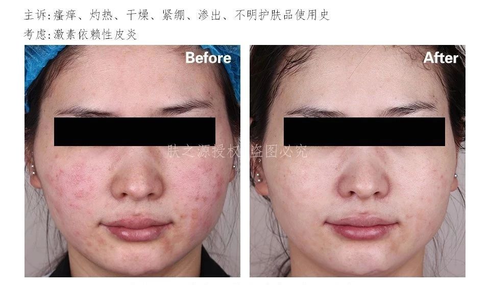 皮肤科激素依赖性皮炎,皮肤科名医激素依赖性皮炎