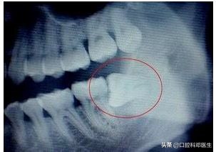 不要让牙齿毁了你的五官,别让一颗牙毁一口牙