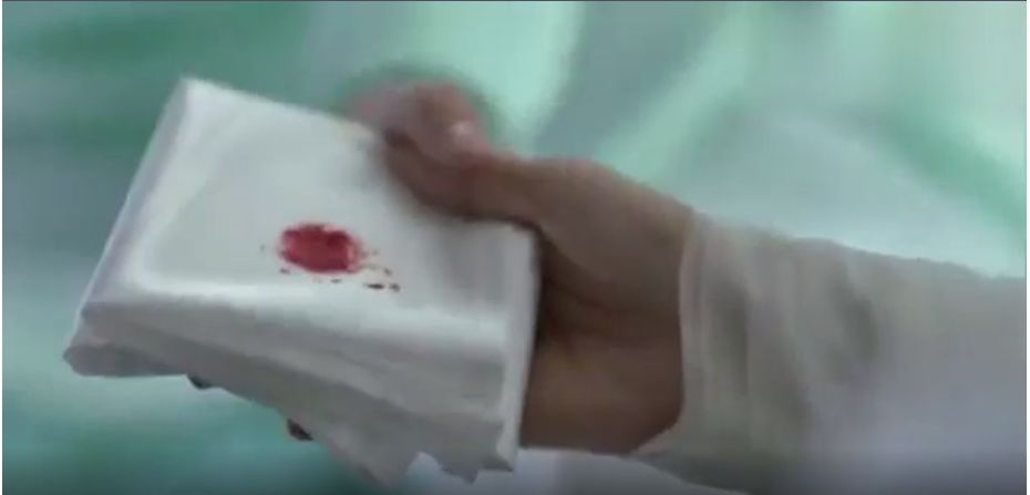 肺结核咳嗽一般是什么症状,咳嗽出血不是鲜血有事吗