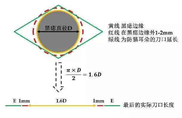 黑痣去除的正确方法是什么,黑痣去除细节注意事项