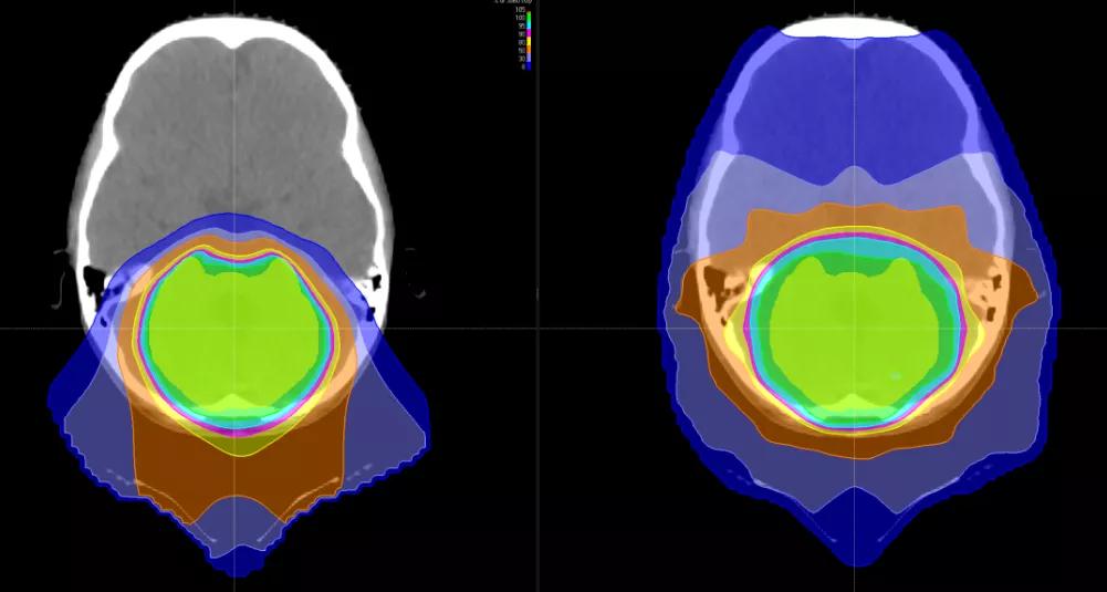 颅内肿瘤引起癫痫能活多久,颅内占位性的病变引起癫痫