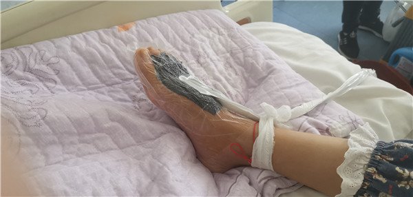 21岁女孩脚掌被截肢,女子脚掌被截肢