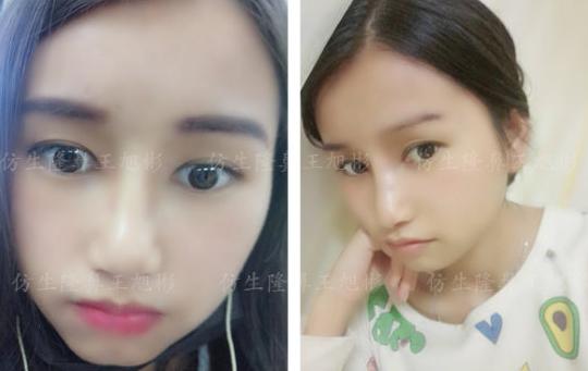 山根低鼻头大隆鼻,鼻根很低的隆鼻后的效果