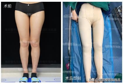 大小腿吸脂后走路,大小腿吸脂可以修饰腿型吗