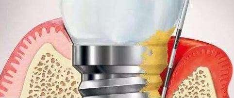 种植的牙齿松动了怎么办,牙齿松动2年可拔牙吗还能种植吗